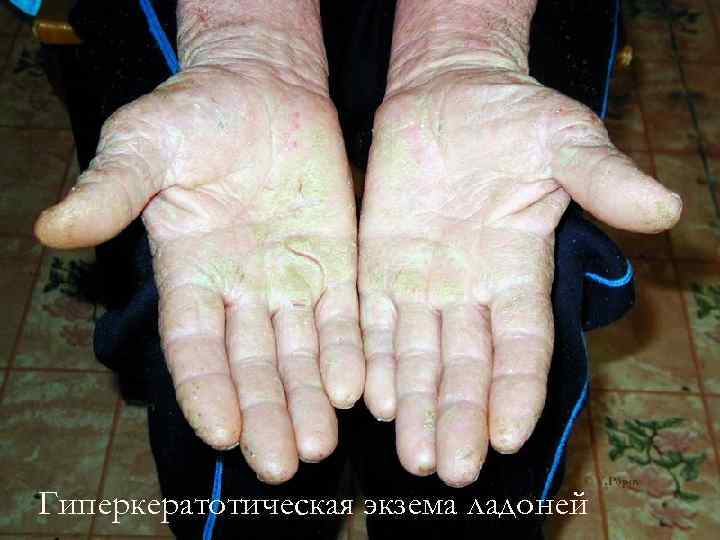 Гиперкератотическая экзема ладоней 
