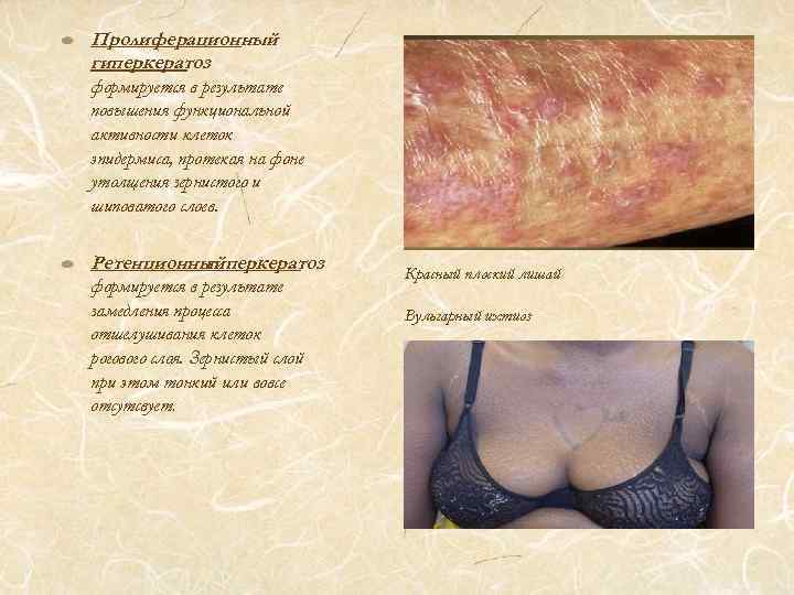 Пролиферационный гиперкератоз формируется в результате повышения функциональной активности клеток эпидермиса, протекая на фоне утолщения