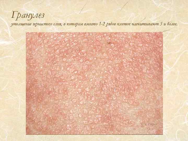 Гранулез утолщение зернистого слоя, в котором вместо 1 -2 рядов клеток насчитывают 5 и