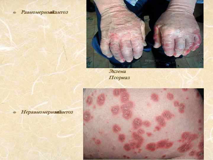 Равномерный акантоз Экзема Псориаз Неравномерный акантоз 