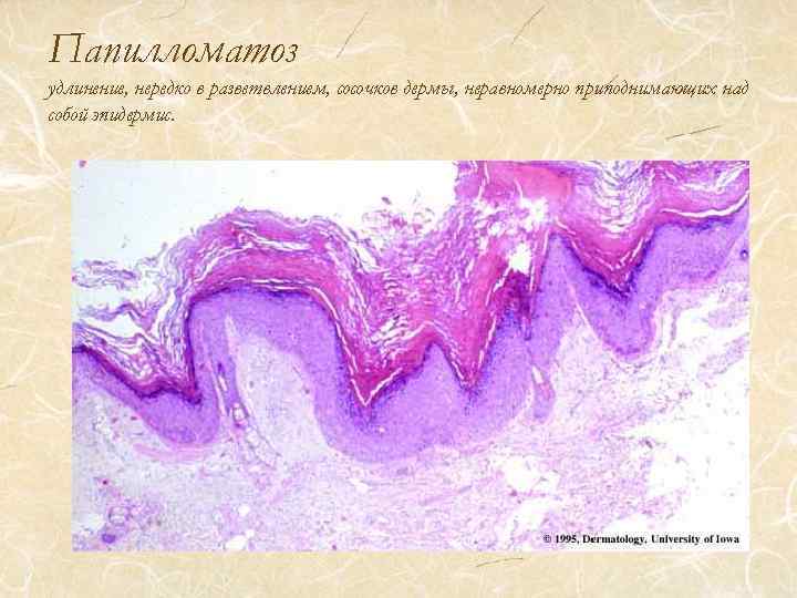 Папилломатоз карциноидный готтрона фото