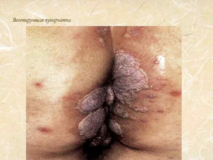 Вегетирующая пузырчатка 