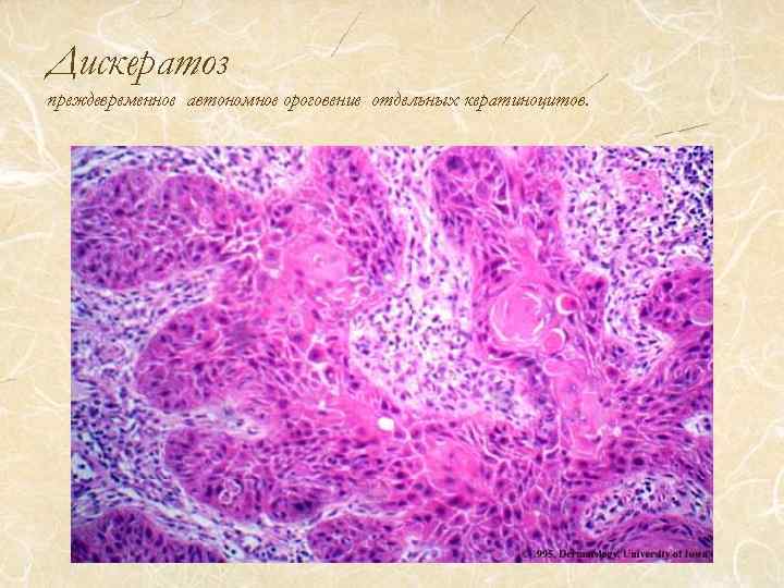 Дискератоз преждевременное автономное ороговение отдельных кератиноцитов. 