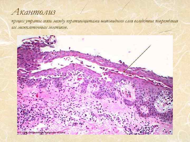 Акантолиз процесс утраты связи между кератиноцитами шиповидного слоя вследствие повреждения их межклеточных мостиков. 