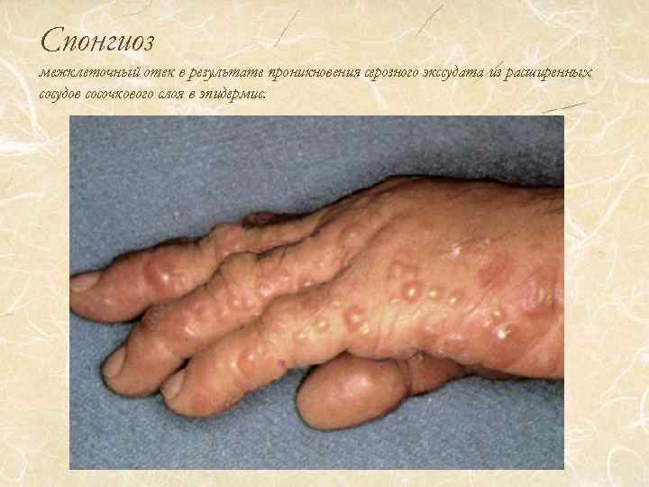 Спонгиоз межклеточный отек в результате проникновения серозного экссудата из расширенных сосудов сосочкового слоя в