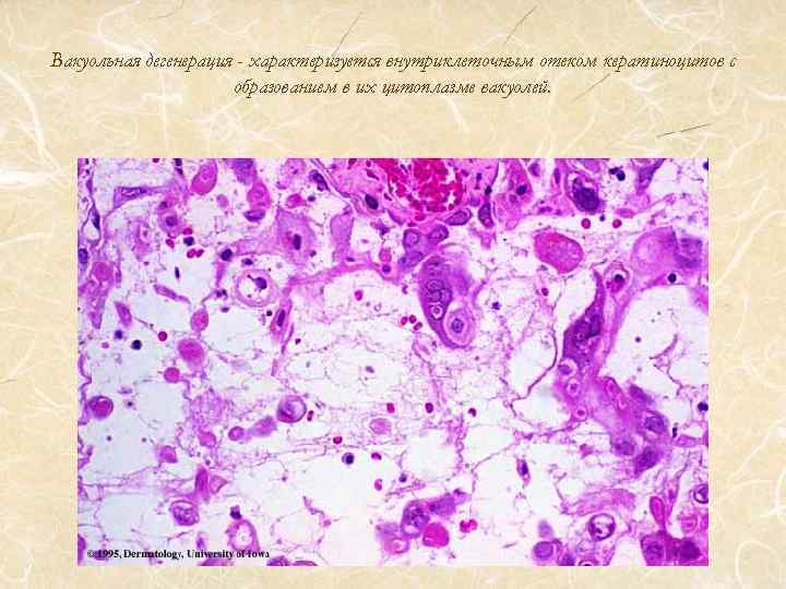 Вакуольная дегенерация - характеризуется внутриклеточным отеком кератиноцитов с образованием в их цитоплазме вакуолей. 