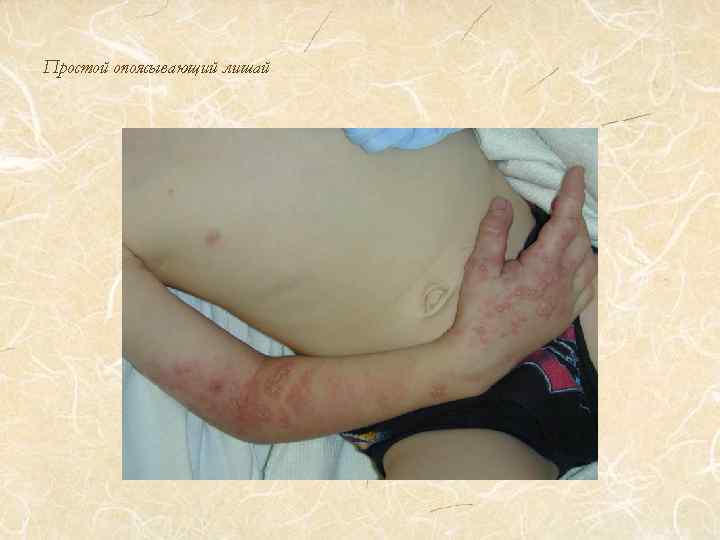 Простой опоясывающий лишай 