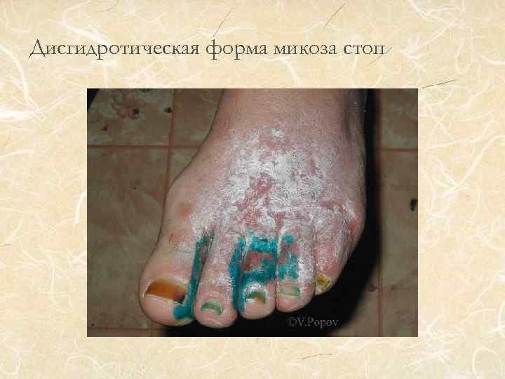 Дисгидротическая форма микоза стоп 
