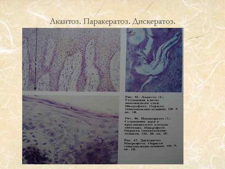 Акантоз. Паракератоз. Дискератоз. 