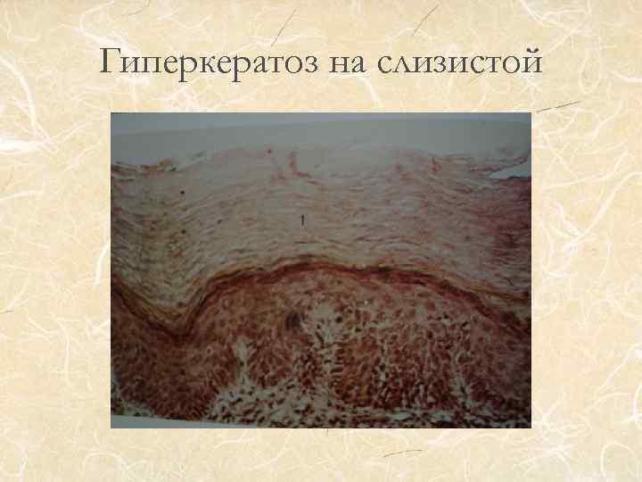 Гиперкератоз на слизистой 