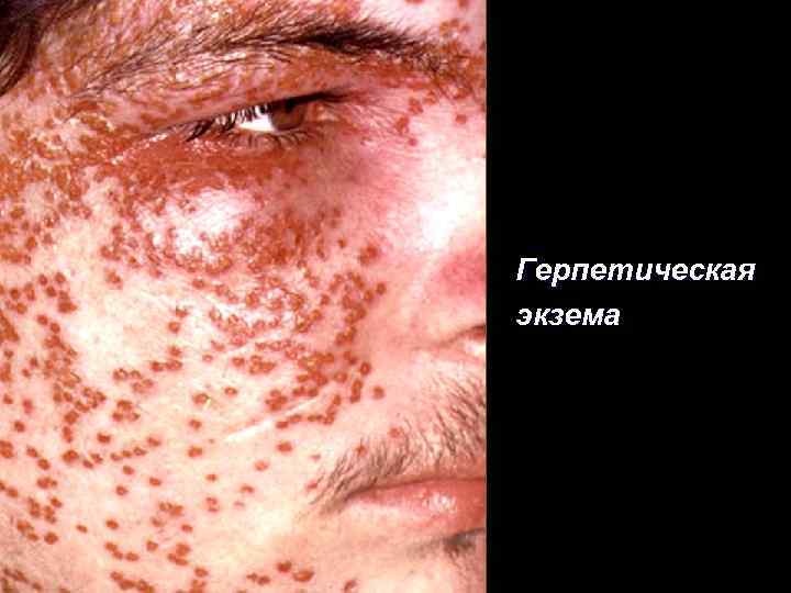 Герпетическая экзема 