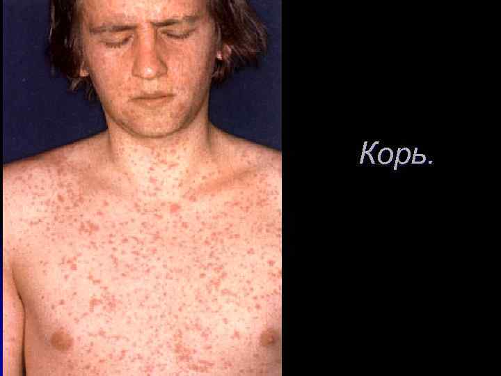Корь. 