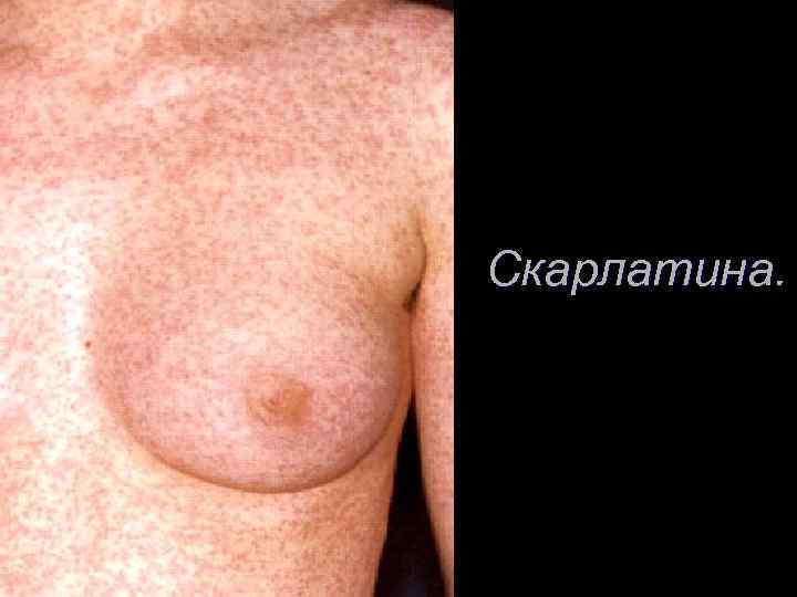 Скарлатина. 