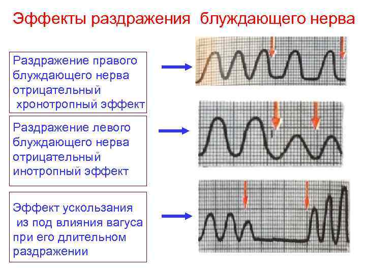 Эффекты раздражения блуждающего нерва Раздражение правого блуждающего нерва отрицательный хронотропный эффект Раздражение левого блуждающего