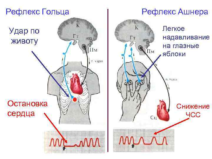 Рефлекс Гольца Удар по животу Остановка сердца Рефлекс Ашнера Легкое надавливание на глазные яблоки