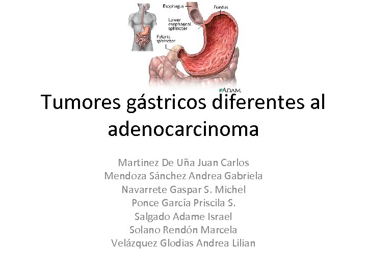 Tumores gástricos diferentes al adenocarcinoma Martinez De Uña Juan Carlos Mendoza Sánchez Andrea Gabriela
