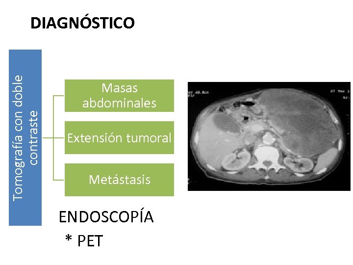 Tomografía con doble contraste DIAGNÓSTICO Masas abdominales Extensión tumoral Metástasis ENDOSCOPÍA * PET 