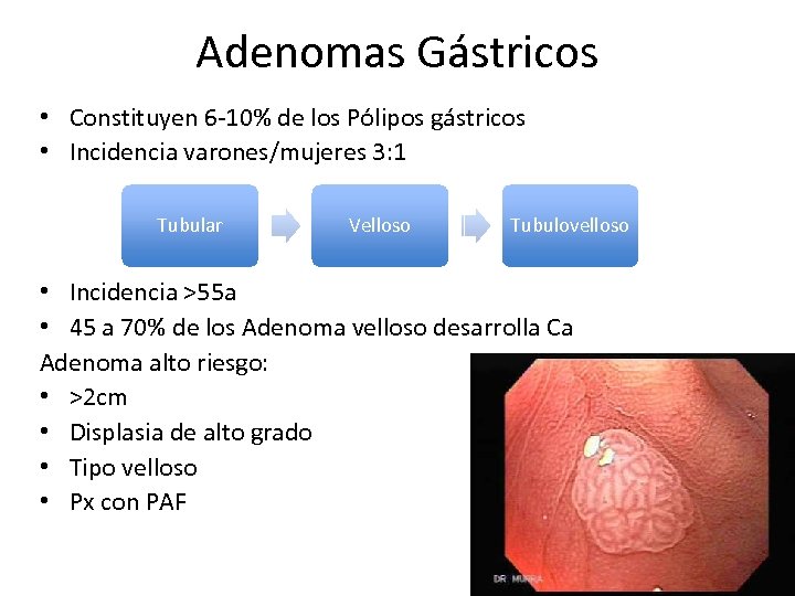 Adenomas Gástricos • Constituyen 6 -10% de los Pólipos gástricos • Incidencia varones/mujeres 3: