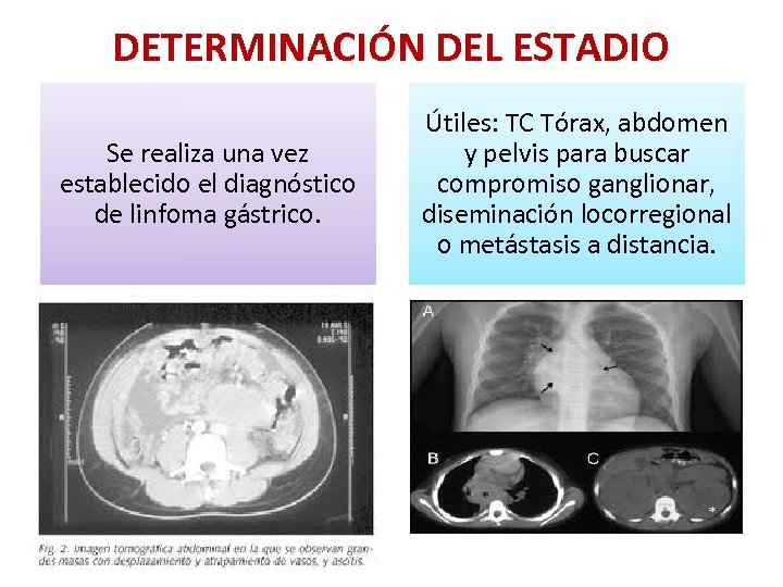 DETERMINACIÓN DEL ESTADIO Se realiza una vez establecido el diagnóstico de linfoma gástrico. Útiles:
