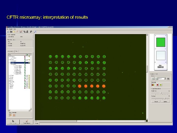 CFTR microarray: interpretation of results 