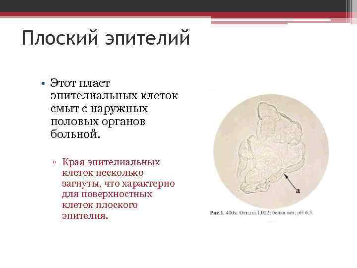 Плоский эпителий • Этот пласт эпителиальных клеток смыт с наружных половых органов больной. ▫