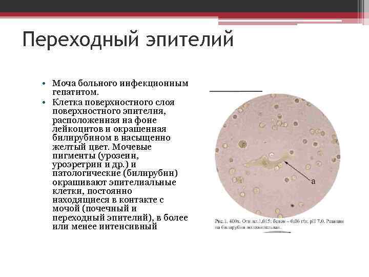 Эпителий в моче повышены. Переходный и почечный эпителий. Почечный и переходный эпителий в моче. Эпителий мочевых путей норма. Эпителий плоский переходный и почечный в моче.