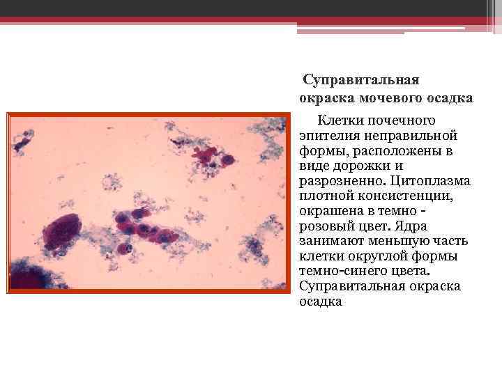 Суправитальная окраска мочевого осадка Клетки почечного эпителия неправильной формы, расположены в виде дорожки и