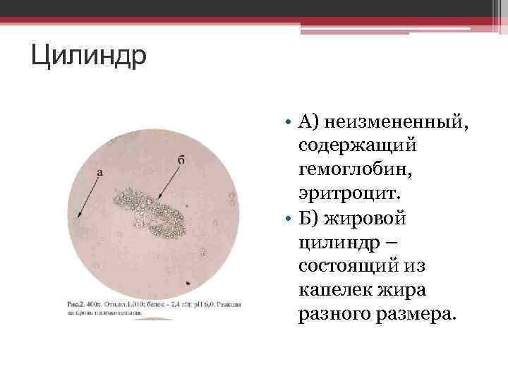 Цилиндр • А) неизмененный, содержащий гемоглобин, эритроцит. • Б) жировой цилиндр – состоящий из