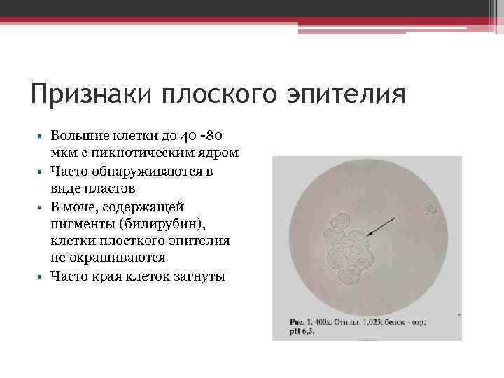 Признаки плоского эпителия • Большие клетки до 40 -80 мкм с пикнотическим ядром •