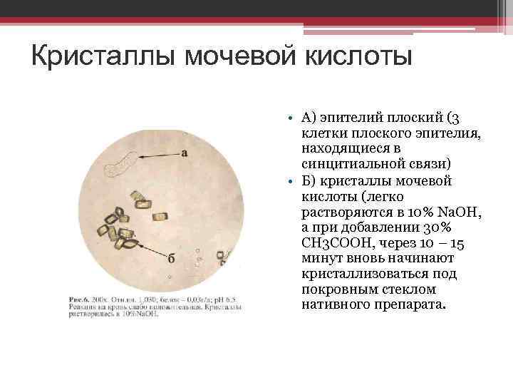 Мочевая соль в моче. Кристаллы мочевой кислоты в моче. Мочекислый натрий в моче под микроскопом. Соли в осадке мочи под микроскопом.