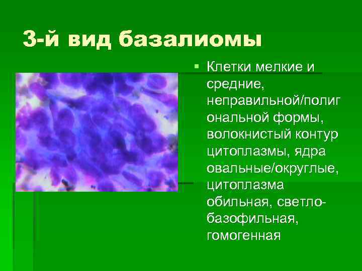 3 -й вид базалиомы § Клетки мелкие и средние, неправильной/полиг ональной формы, волокнистый контур