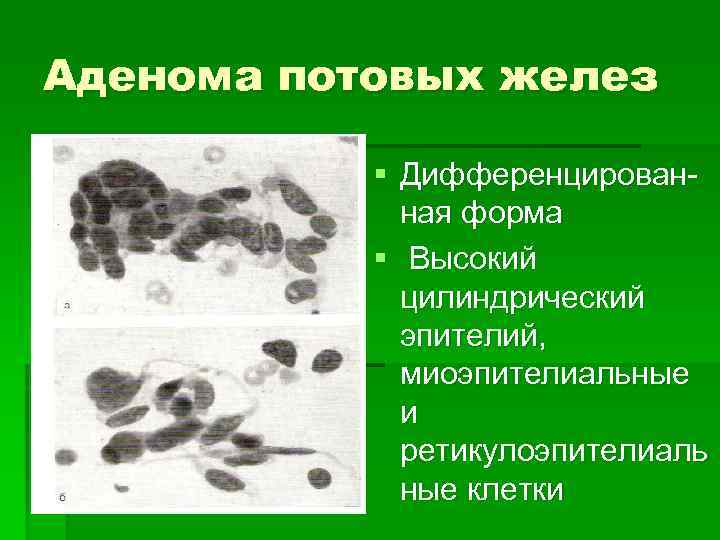 Аденома потовых желез § Дифференцированная форма § Высокий цилиндрический эпителий, миоэпителиальные и ретикулоэпителиаль ные