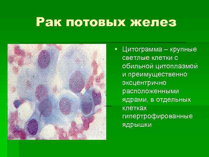 Рак потовых желез § Цитограмма – крупные светлые клетки с обильной цитоплазмой и преимущественно