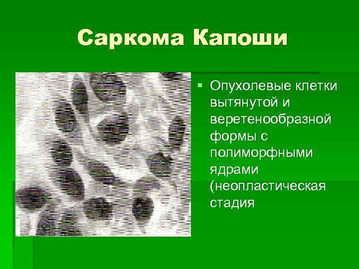 Саркома Капоши § Опухолевые клетки вытянутой и веретенообразной формы с полиморфными ядрами (неопластическая стадия