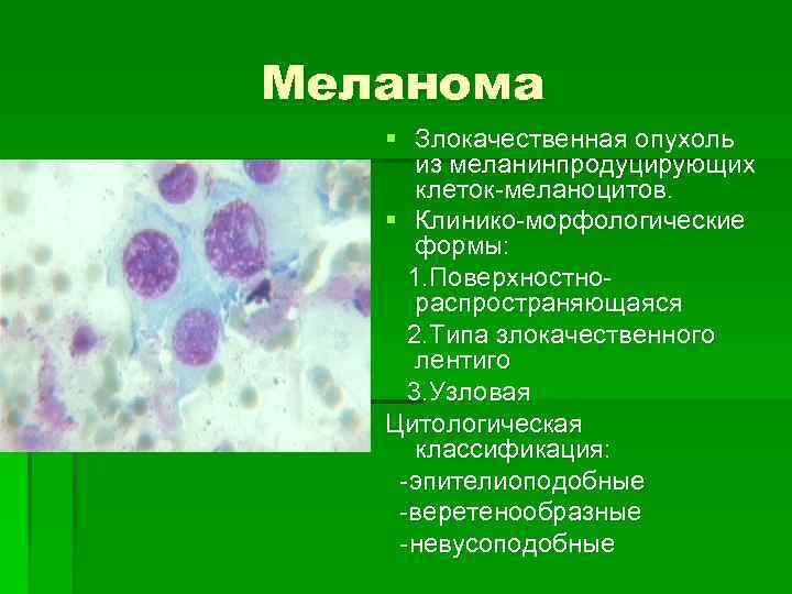 2 степень злокачественности рака. Невоидная меланома гистология. Мелонома злокачестаенная опу. Атипичные клетки в цитологии кожи. Меланома злокачественная опухоль.