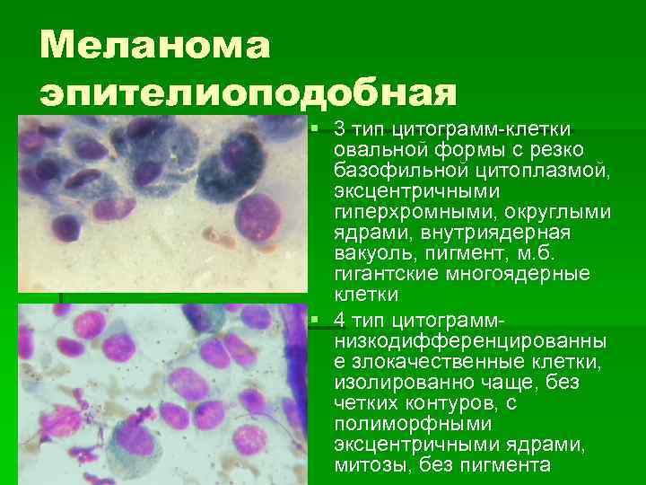 Меланома эпителиоподобная § 3 тип цитограмм-клетки овальной формы с резко базофильной цитоплазмой, эксцентричными гиперхромными,