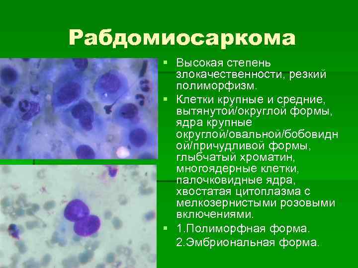 Рабдомиосаркома § Высокая степень злокачественности, резкий полиморфизм. § Клетки крупные и средние, вытянутой/округлой формы,