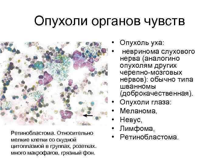 Опухоли органов чувств Ретинобластома. Относительно мелкие клетки со скудной цитоплазмой в группах, розетках. много