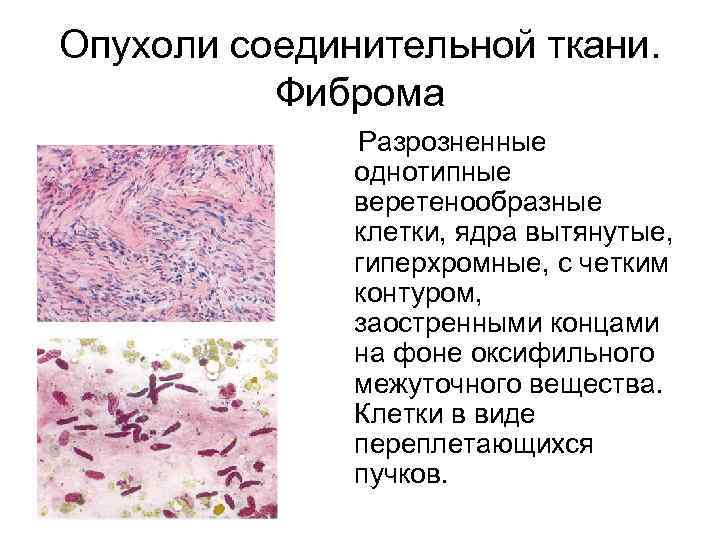 Опухоли соединительной ткани. Фиброма Разрозненные однотипные веретенообразные клетки, ядра вытянутые, гиперхромные, с четким контуром,