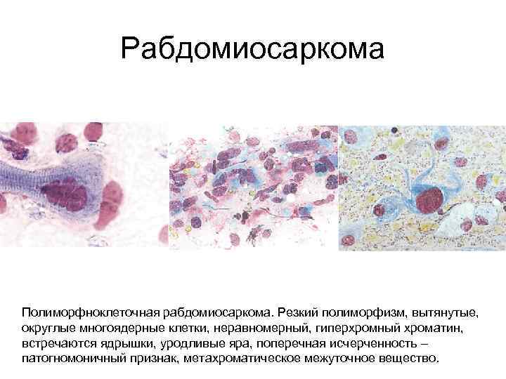 Рабдомиосаркома Полиморфноклеточная рабдомиосаркома. Резкий полиморфизм, вытянутые, округлые многоядерные клетки, неравномерный, гиперхромный хроматин, встречаются ядрышки,