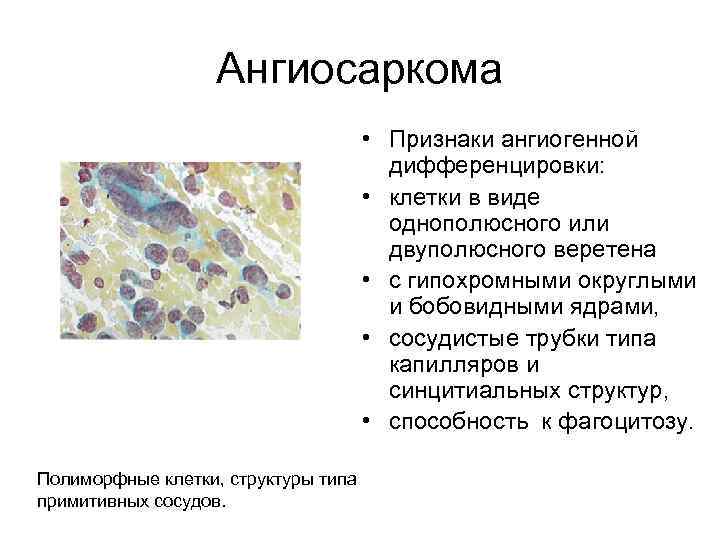 Ангиосаркома • Признаки ангиогенной дифференцировки: • клетки в виде однополюсного или двуполюсного веретена •