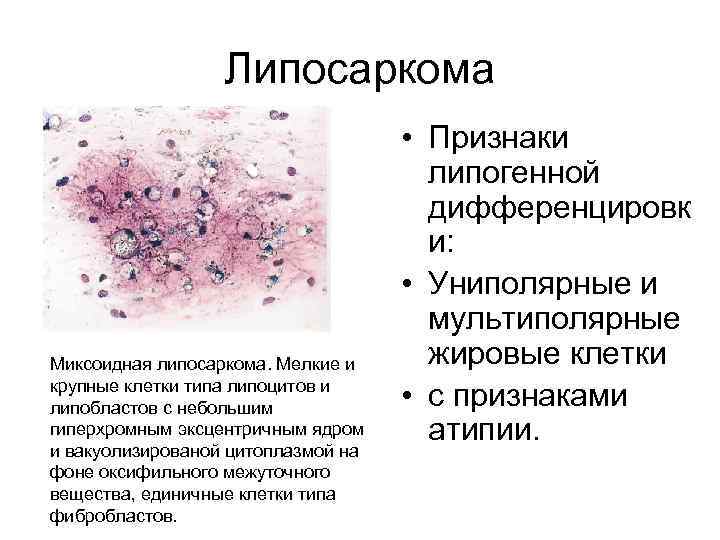 Липосаркома Миксоидная липосаркома. Мелкие и крупные клетки типа липоцитов и липобластов с небольшим гиперхромным