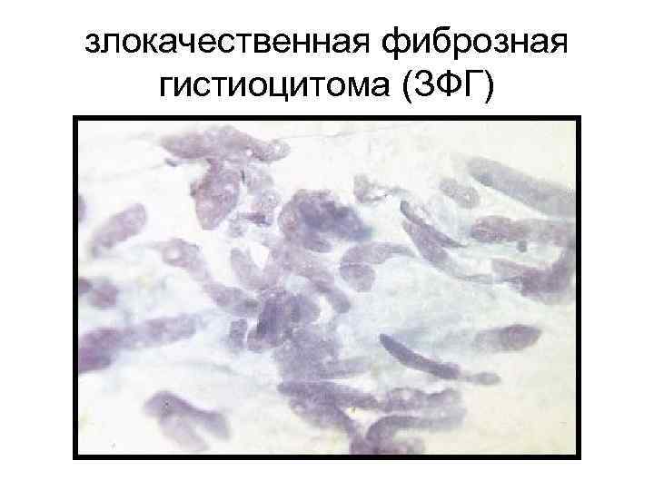 злокачественная фиброзная гистиоцитома (ЗФГ) 