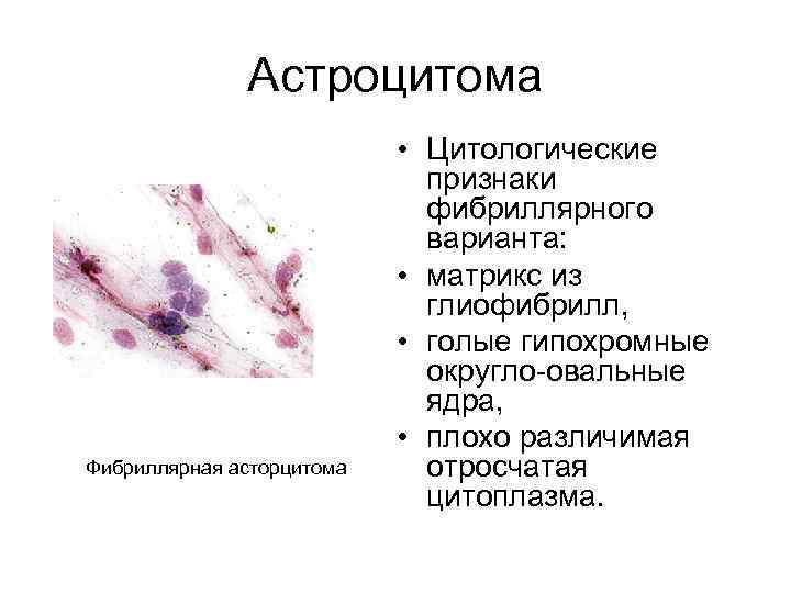 Астроцитома Фибриллярная асторцитома • Цитологические признаки фибриллярного варианта: • матрикс из глиофибрилл, • голые