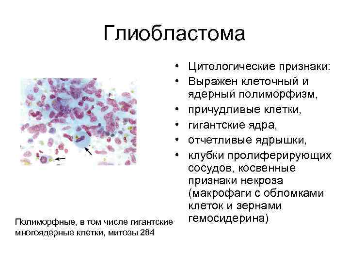 Глиобластома • Цитологические признаки: • Выражен клеточный и ядерный полиморфизм, • причудливые клетки, •