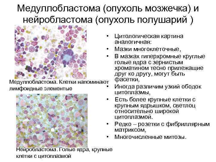 Медуллобластома (опухоль мозжечка) и нейробластома (опухоль полушарий ) • Цитологическая картина аналогичная: • Мазки