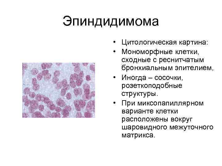 Эпиндидимома • Цитологическая картина: • Мономорфные клетки, сходные с реснитчатым бронхиальным эпителием, • Иногда