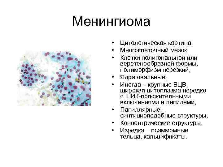 Менингиома • Цитологическая картина: • Многоклеточный мазок, • Клетки полигональной или веретенообразной формы, полиморфизм