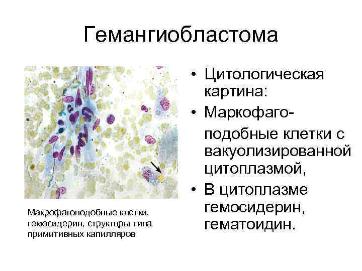 Гемангиобластома Макрофагоподобные клетки, гемосидерин, структцры типа примитивных капилляров • Цитологическая картина: • Маркофагоподобные клетки