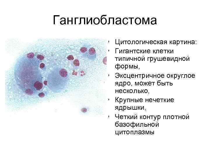 Ганглиобластома • Цитологическая картина: • Гигантские клетки типичной грушевидной формы, • Эксцентричное округлое ядро,